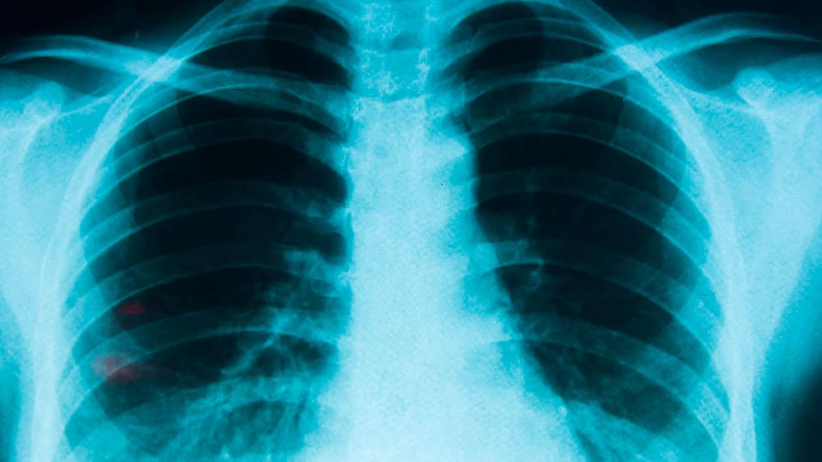 Radiografía de pulmones relacionada con el riesgo de cáncer por exposición al radón en España
