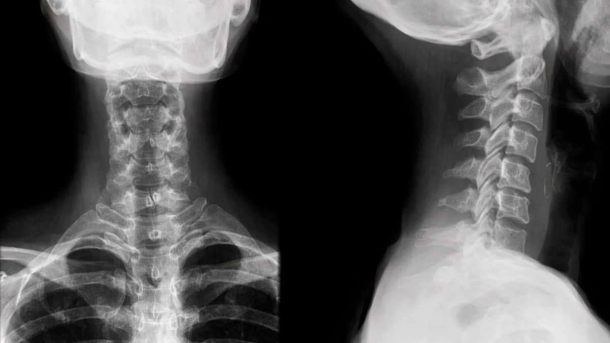 Radiografía cervical relacionada con jubilación anticipada por discapacidad reconocida por el INSS