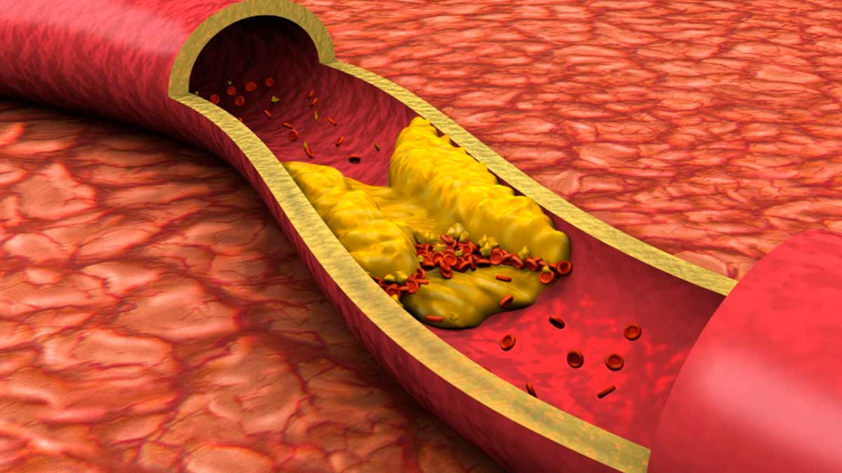 Arteria con acumulación de colesterol LDL y placas que aumentan riesgo cardiovascular