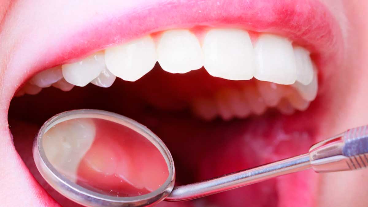 Dentista revisando dientes con espejo desgaste esmalte dental.