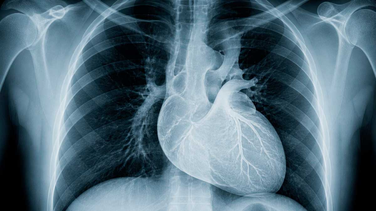 Radiografía corazón salud cardiovascular presión arterial