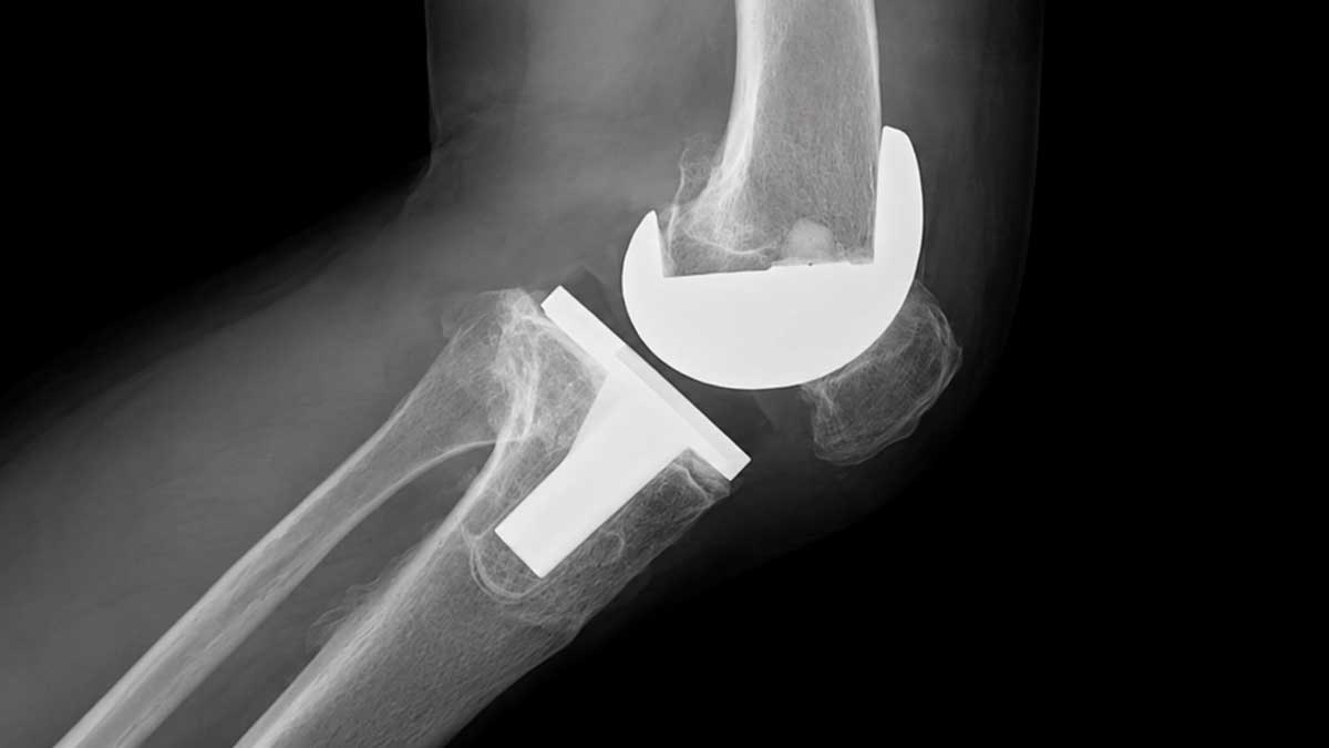 Radiografía de rodilla con prótesis relacionada con incapacidad permanente total