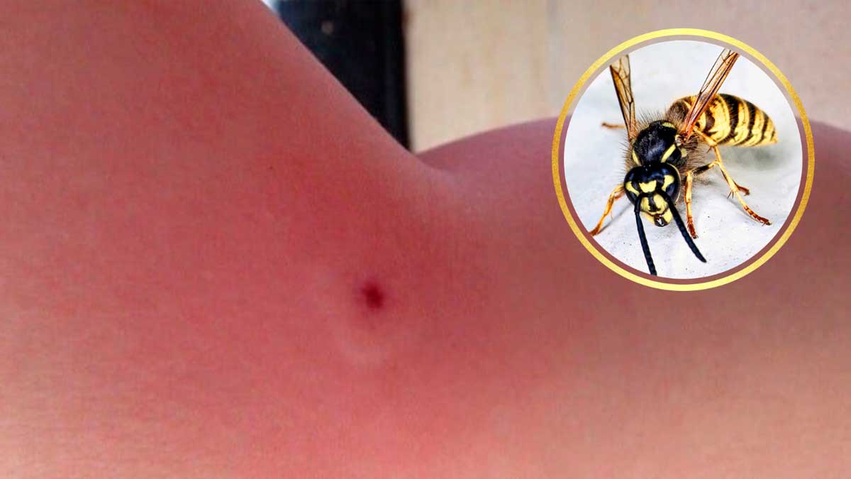 Picadura de avispa con enrojecimiento y síntomas de alarma en la piel